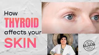 How Thyroid affects your skin | Know from Dermatologist- Dr. Nivedita Dadu