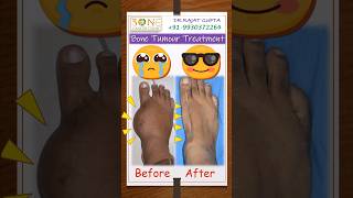 Bone Tumour Recurrent GCT foot Haddi ki rasoli पैर की गांठ -Dr Rajat Gupta @bonecancerclinic