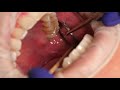 inferior alveolar nerve block demonstration and overview 4k