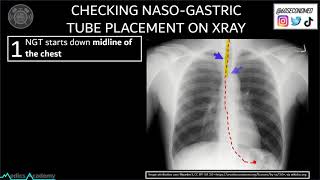 55 SECONDS on Checking NASOGASTRIC TUBE Placement on X-Ray