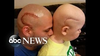 Father Tattoos Son's Scar on His Head