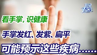 手是身体疾病的“照妖镜”，手掌发红、发紫、扁平，可能预示这些疾病…… 【我是大医生】