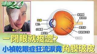 一閉眼就痠澀？小禎乾眼症狂流淚竟角膜破皮 健康2.0