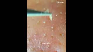 Nose Blackhead Removal Whiteheads On The Nose Look At The Beautifully Stripped