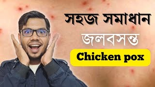 জলবসন্ত বা চিকেন পক্স (Chicken pox) হলে করনীয় লক্ষণ চিকিৎসা