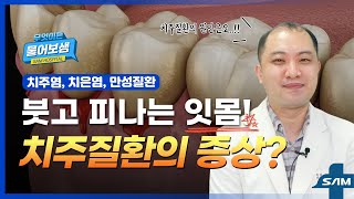 붓고 피나는 잇몸! 치주질환의 증상인가요? [무엇이든 물어보샘 #20]