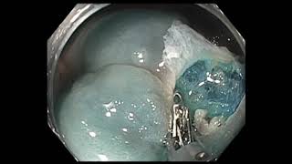 Colonoscopy: Cecal Granular Cell Tumor - rare pathology