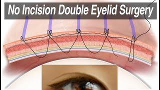 Non-Incisional Asian Double Eyelid Surgery (Suture Technique for Monolid Correction) Animation