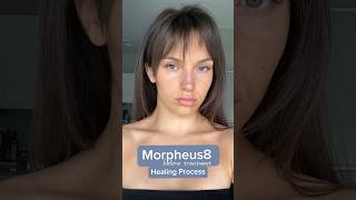 Morpheus8 Healing Timeline & Before / After! #morpheus8 #morpheus8beforeandafter #morpheus8healing