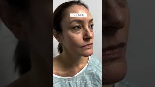 Upper and Lower Eyelid Rejuvenation - Dr. Kami Parsa