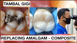 Step by Step Replacing Amalgam to Resin Composite | General Dentist Griya RR