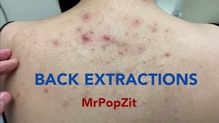 Tons of blackheads on the back. Acne extractions. Blackheads and whiteheads. Min