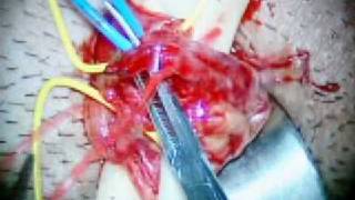 Varicocele Surgery