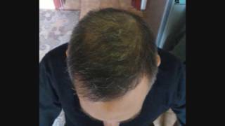 ASMED - Dr. Koray Erdogan - 5009 Grafts FUE #hairtransplant #hairtransplantturkey