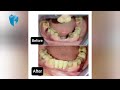 Removable Partial Denture (RPD) | Bright Line Dental Care | Nepali Dentist | Prosthodontic | Nepal