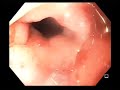 gastro gastric fistula with associated anastomotic ulcer following gastric bypass