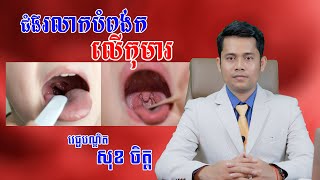 ជំងឺរលាកបំពង់កលើកុមារ (Acute pharyngitis)-  វេជ្ជបណ្ឌិត សុខ ចិត្ត [ VIDEO ]