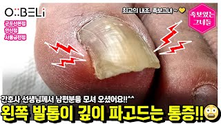 최근에 왼발톱이 너무 아프셔서 관리받고자 발톱을 길러오신^^ 간호사 선생님께서 남편분 모시고 오심!🥰 #무좀발톱 #내성발톱 #발톱 #toenails #ingrown_toenail