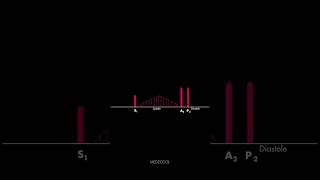 Atrial Septal Defect Heart Sound