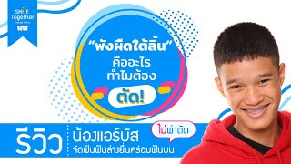 รีวิวเคส::ฟันล่างยื่นกับพังผืดใต้ลิ้นคืออะไร? ทำไมต้องตัด