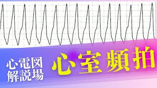 心電図解説場（心室頻拍編）