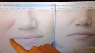 Juvederm or Restylane for Lip Enhancement   Which is better??   Brittany White NP Skin by Lovely