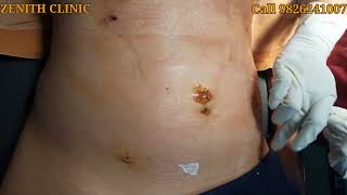 female to male top surgery post operative care.zenith clinic.Dr sumeet jaiswal i