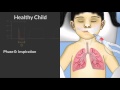 Capnography by C. Smallwood | OPENPediatrics