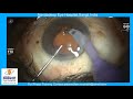 toric tridiff shallow ac dr sourabh patwardhan live cataract surgery. for training call 9220001000