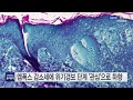 엠폭스 감소세에 위기경보 단계 관심 으로 하향 ytn 사이언스