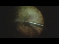 argus ii retinal prosthesis malrotation and repositioning supplementary video 96570