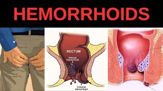 Signs and Symptoms of Hemorrhoids, Internal vs. External Hemorrhoid Symptoms  Hemorrhoidal Disease
