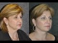 55 Year Woman 10 Days After Facelift Recovery Before and After | #deepplanefacelift