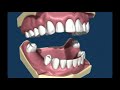 removable partial dentures