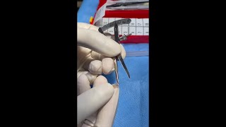 Vitrectomy and Intraoperative Suprachoroidal Viscopexy Using Viscous Fluid Control Injection