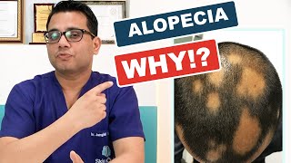 What is Alopecia areata ?- Causes, Diagnosis & Hair Re-growth Treatments? @SkinQ
