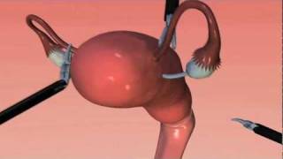 How is robotic surgery performed?