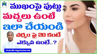 ముఖం పై పుట్టు మచ్చలు ఉంటే ఇలా చేయండి ! | Birthmark | Dr Manthena Satyanarayana Raju | HEALTH MANTRA