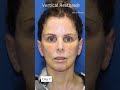 8 day vertical restore facelift healing u0026 recovery progression