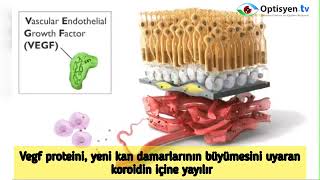 Sarı Nokta - Makula Dejenerasyonu nedir ? Belirtileri nelerdir ?