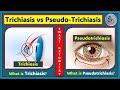 Trichiasis vs Pseudotrichiasis- What is Trichiasis? what is Pseudotrichiasis?