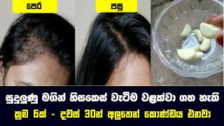 සුදුලුණු මගින් හිසකෙස් වැටීම පාලනය කරන ක්‍රම 6ක් - 6 Natural Remedies to Treat Hair Loss