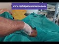 treatment of plantar fascitis by prp injection by dr.vishal gunjal