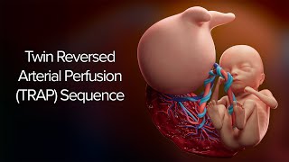 Twin Reversed Arterial Perfusion (TRAP) Sequence | Cincinnati Childrens