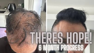 HOW I REVERSED HAIR LOSS / BALDING - 6 MONTH PROGRESS