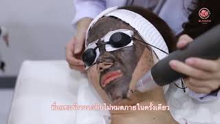 Ultracharcoal Laser เลเซอร์ลดรอยดำ X3  | Blossom Clinic