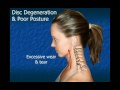 Cervical Disc Degeneration