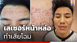 เลเซอร์หน้าหล่อทำเสียโฉม | ข่าวช่อง8