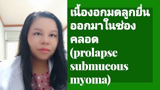 เนื้องอกมดลูกยื่นออกมาจากมดลูก ( prolapse submucous myoma) by หมอดาราวดี