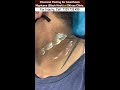 chemical peeling for acanthosis nigricans black neck at skinaa clinic viral shorts